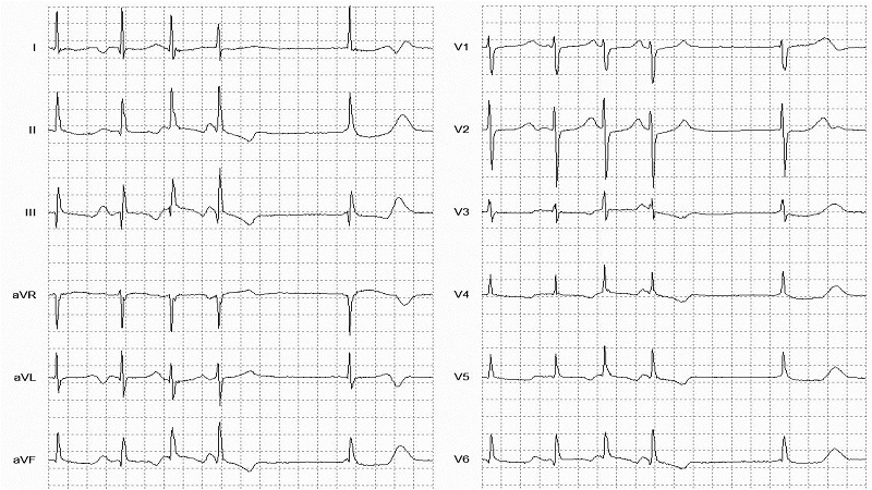 Nodal (junctional) escape beat 12 Lead EKG